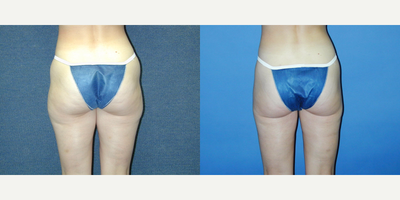 Smart Lipo before and after photo