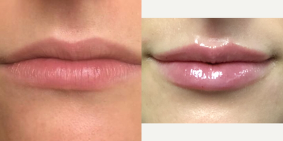 Lip Fillers before and after photo