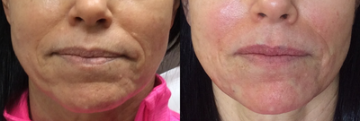 Thread Lift before and after photo