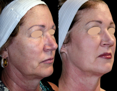 Bellafill before and after photo