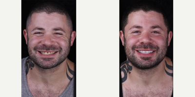 Dental Crown before and after photo