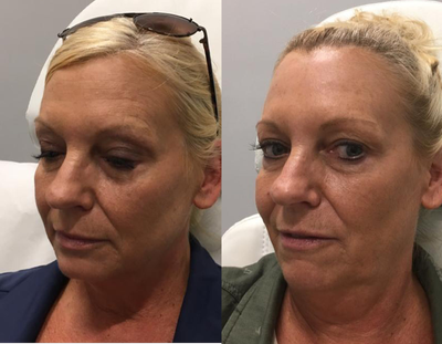 Dysport before and after photo