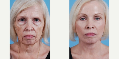 Facelift before and after photo