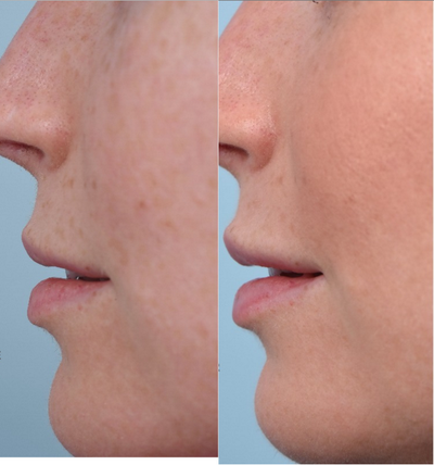 Lip Fillers before and after photo