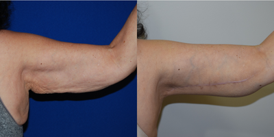 Arm Lift before and after photo