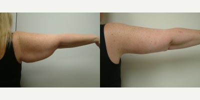 Arm Lift before and after photo