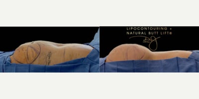 Liposuction before and after photo