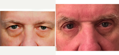 Eyelid Surgery before and after photo