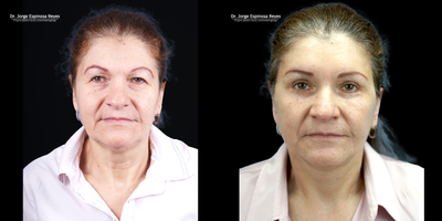 Eyelid Surgery before and after photo