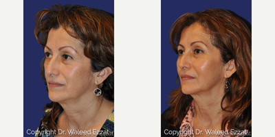 Eyelid Surgery before and after photo