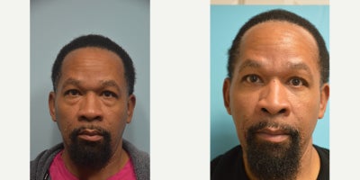 Eyelid Surgery before and after photo
