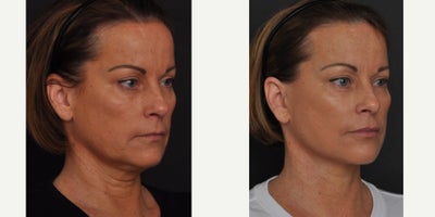 Facelift before and after photo