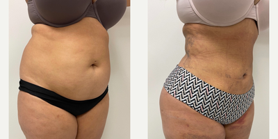 Lipo 360 BBL before and after photo