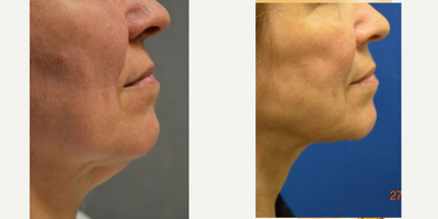 Nonsurgical Neck Lift before and after photo