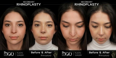 Revision Rhinoplasty before and after photo