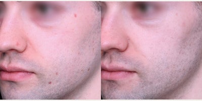 Vbeam before and after photo