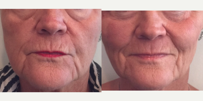 Dermal Fillers before and after photo