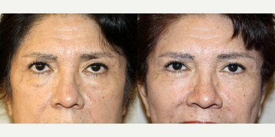 Eyelid Surgery before and after photo