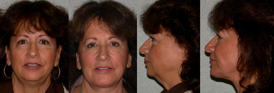 Facelift before and after photo