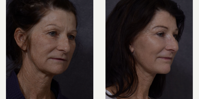 Facelift before and after photo