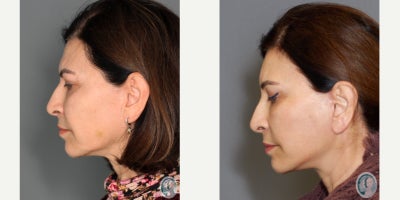 Facelift before and after photo