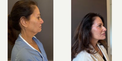 Facelift before and after photo