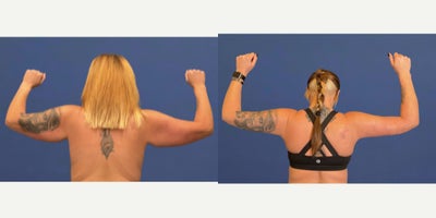 Liposuction before and after photo