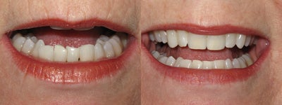 Tooth Repair before and after photo