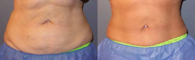 CoolSculpting before and after photo