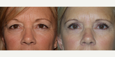 Eyelid Surgery before and after photo