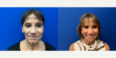 MACS Facelift before and after photo