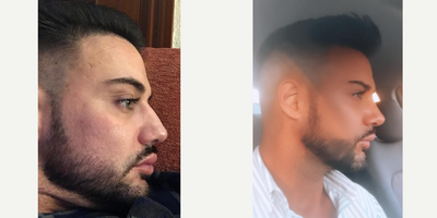 Rhinoplasty before and after photo