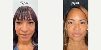 Botox before and after photo
