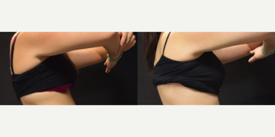 CoolSculpting before and after photo