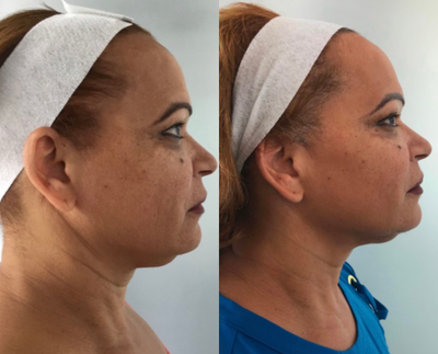 Dermal Fillers before and after photo
