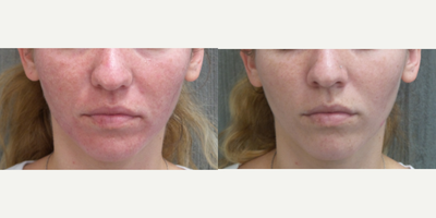 Laser Genesis before and after photo
