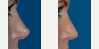 Revision Rhinoplasty before and after photo
