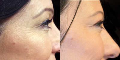 Xeomin before and after photo