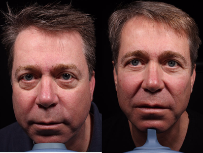 Bellafill before and after photo