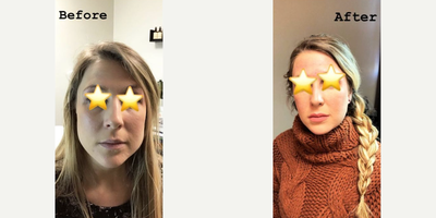 Botox before and after photo