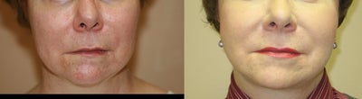 Facelift before and after photo