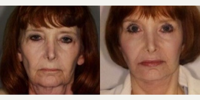 Facelift before and after photo