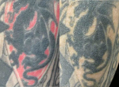 PicoSure before and after photo