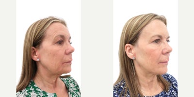 before and after image
