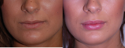 Juvederm before and after photo