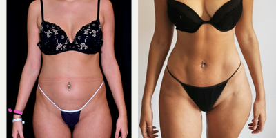 Vaser Liposuction before and after photo