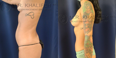 Breast Augmentation before and after photo