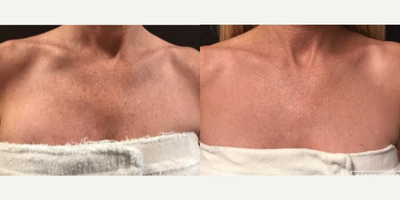 Halo Laser before and after photo