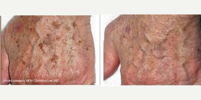 IPL before and after photo