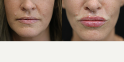 Restylane Silk before and after photo